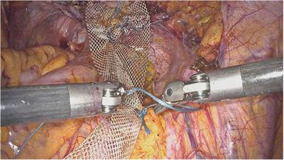 The first 60 cases of robotic sacrocolpopexy with the novel HUGO RAS system: feasibility, setting and perioperative outcomes